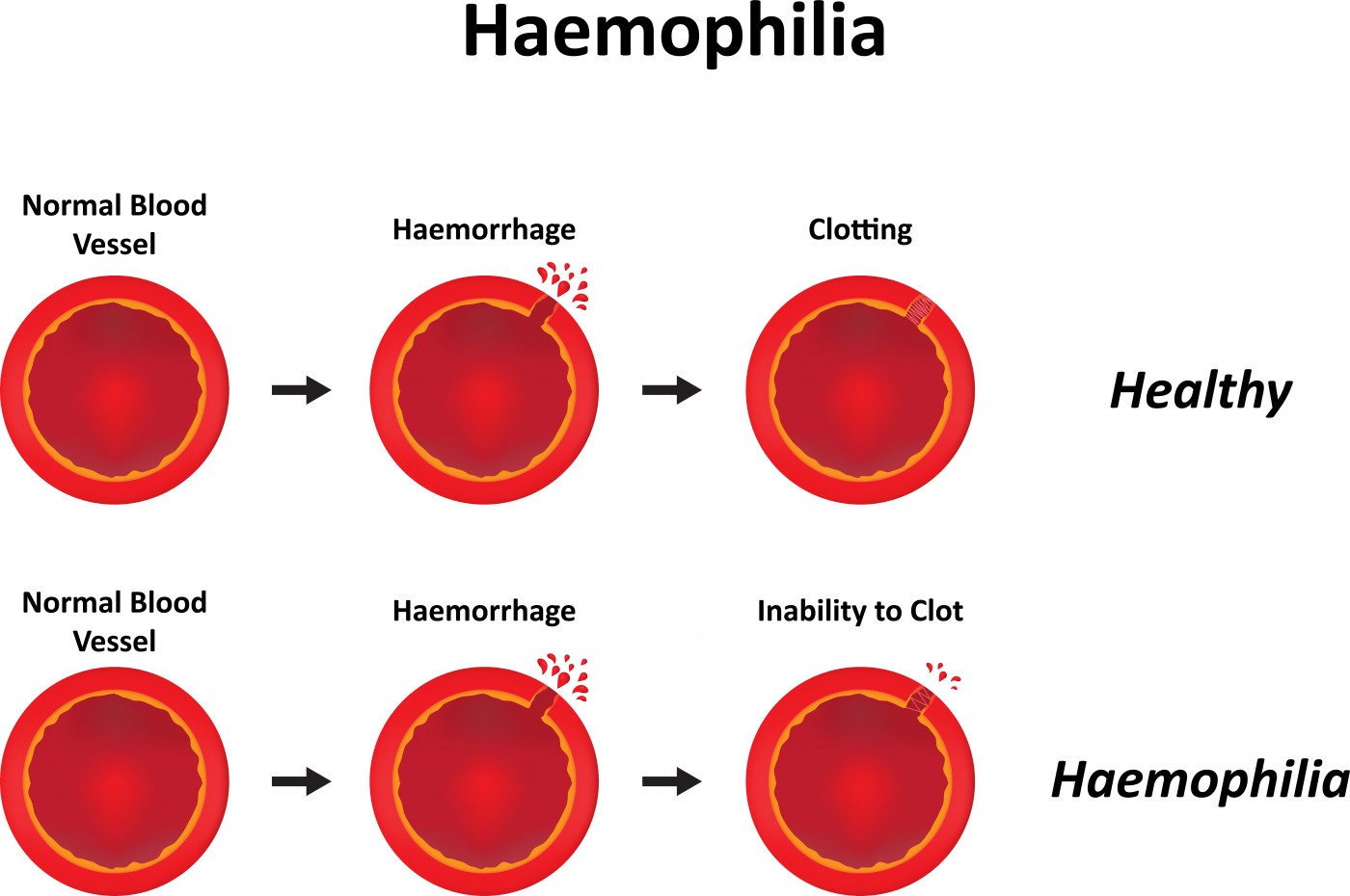 Types of hemophilia  Hemophilia News Today