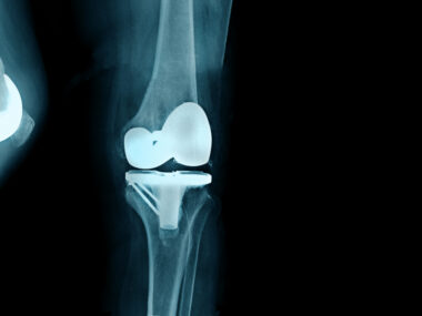 Cyklokapron and joint surgery