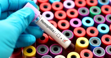 immunoadsorption, acquired hemophilia