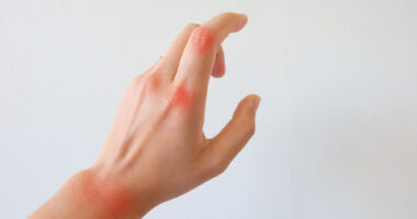 should I infuse? | Hemophilia News Today | A stock photo of a woman's hand with red marks on her wrist and knuckles to identify areas of pain.