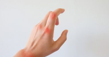 should I infuse? | Hemophilia News Today | A stock photo of a woman's hand with red marks on her wrist and knuckles to identify areas of pain.