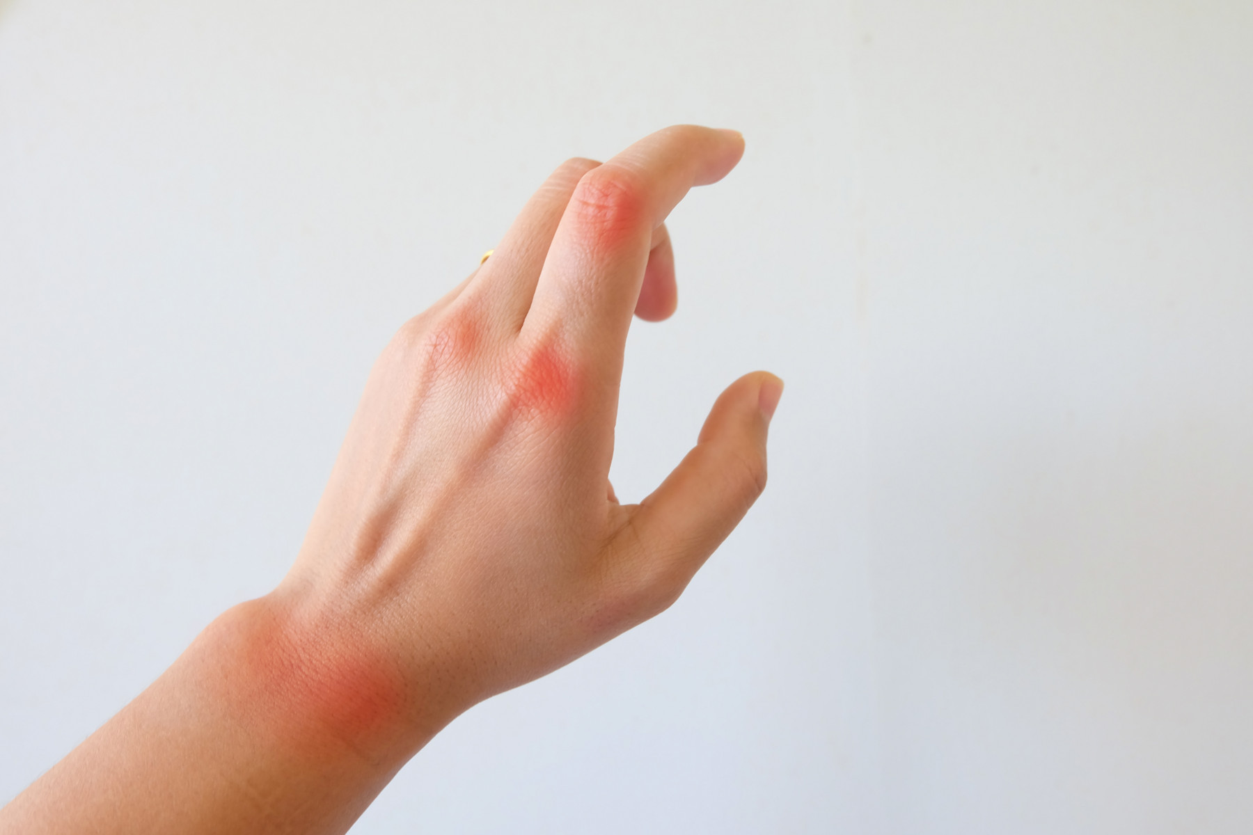 should I infuse? | Hemophilia News Today | A stock photo of a woman's hand with red marks on her wrist and knuckles to identify areas of pain.