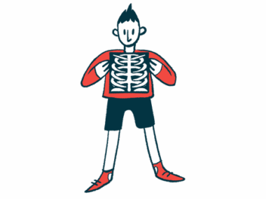 bone disorders for hemophilia carriers | Hemophilia News Today | illustration of a bone X-ray