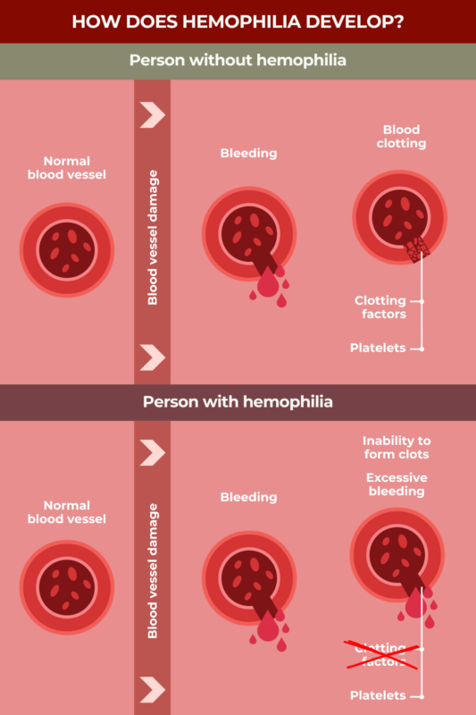 Hemophilia development infographic