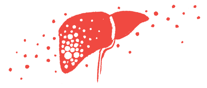 Liver Cancer Risk Significantly Elevated in Japanese Men with Hemophilia and HIV